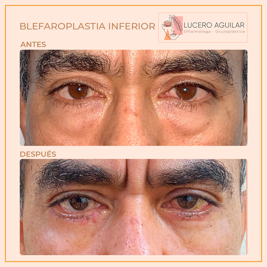 Blefaroplastias inferior