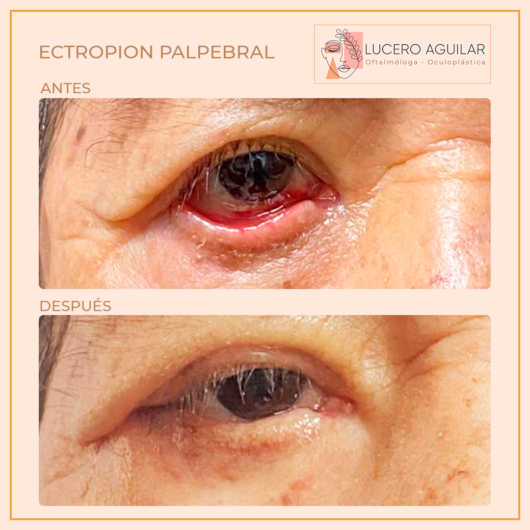 ECTROPION PALPEBRAL